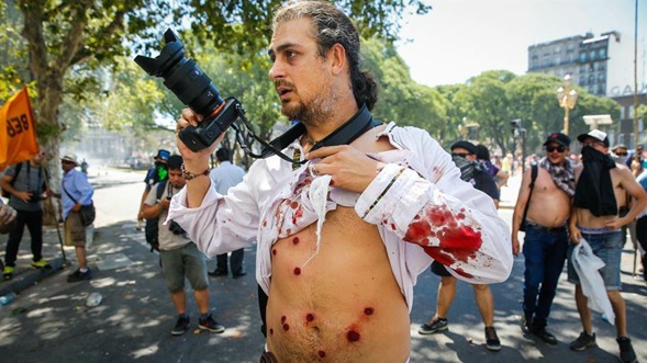 Un reportero gráfico, cámara en mano, exhibe diez heridas provocadas por balas de goma en su torso. Estaba en las cercanías del Congreso cubriendo la manifestación cuando recibió los impactos.