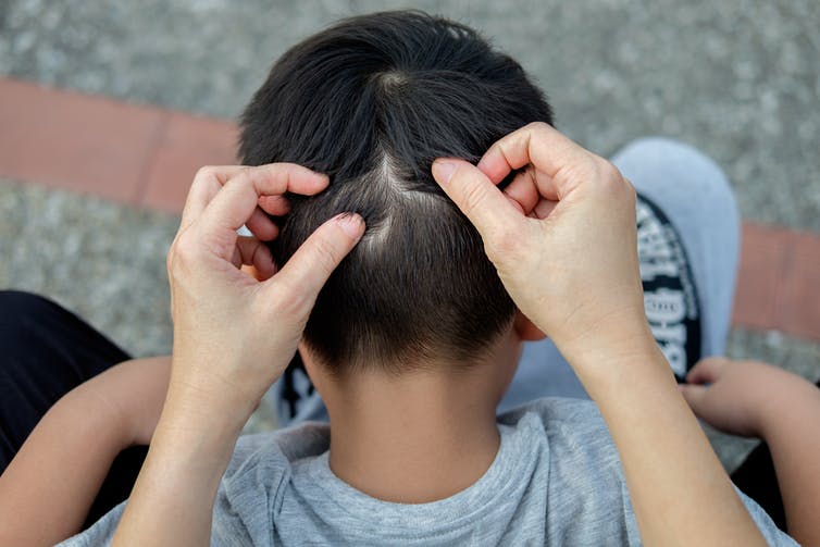 Los piojos, un tipo de ectoparásito, se alojan con frecuencia en la cabezas infantiles.
