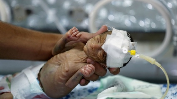 En Yemen un 30% de los recién nacidos son prematuros.- FOTO: REUTERS