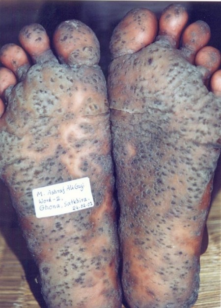 Envenenamiento por arsénico en Bangladesh.