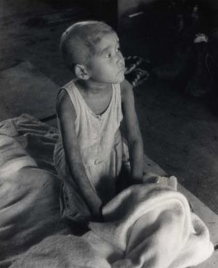 Una niña de Nagasaki que perdió el cabello a causa de la radiactividad.